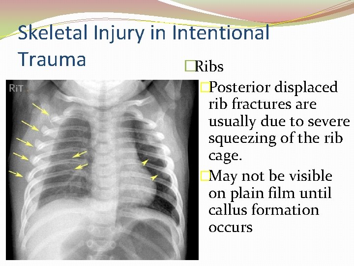 Skeletal Injury in Intentional Trauma �Ribs �Posterior displaced rib fractures are usually due to