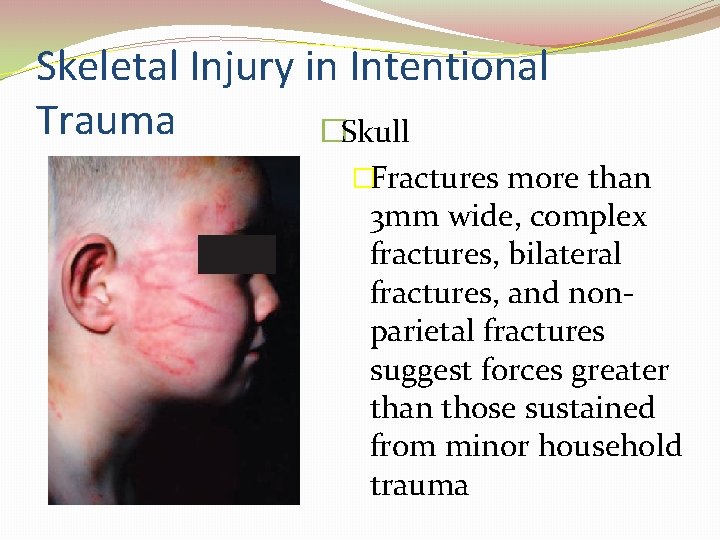 Skeletal Injury in Intentional Trauma �Skull �Fractures more than 3 mm wide, complex fractures,