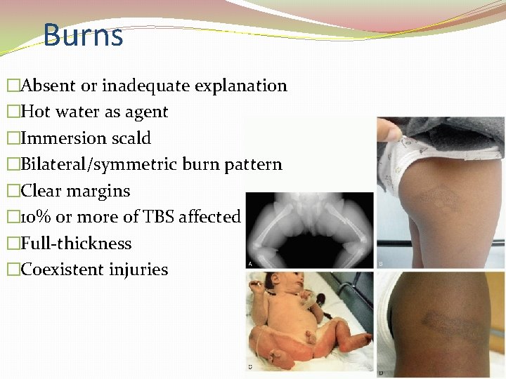 Burns �Absent or inadequate explanation �Hot water as agent �Immersion scald �Bilateral/symmetric burn pattern