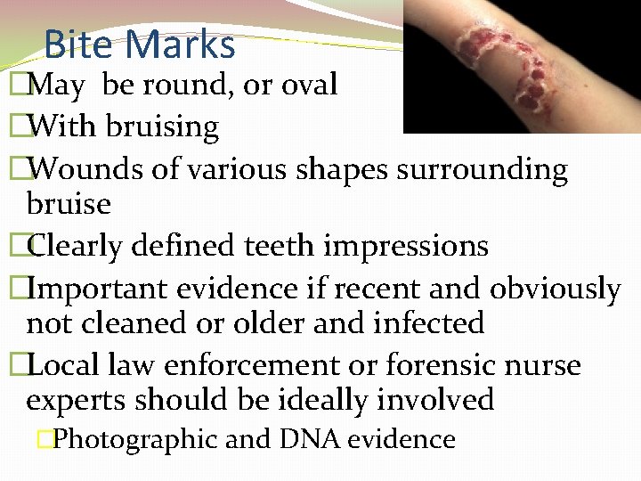 Bite Marks �May be round, or oval �With bruising �Wounds of various shapes surrounding