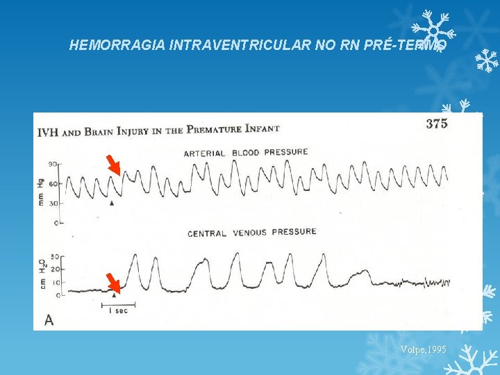 HEMORRAGIA INTRAVENTRICULAR NO RN PRÉ-TERMO Volpe, 1995 HEMORRAGIA INTRAVENTRICULAR NO RN PRÉ-TERMO Volpe, 1995