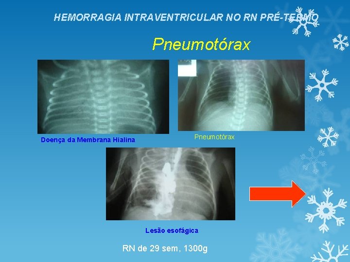 HEMORRAGIA INTRAVENTRICULAR NO RN PRÉ-TERMO Pneumotórax Doença da Membrana Hialina Pneumotórax Lesão esofágica RN HEMORRAGIA INTRAVENTRICULAR NO RN PRÉ-TERMO Pneumotórax Doença da Membrana Hialina Pneumotórax Lesão esofágica RN