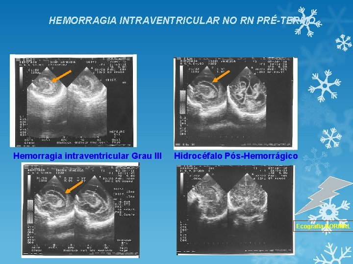 HEMORRAGIA INTRAVENTRICULAR NO RN PRÉ-TERMO Hemorragia intraventricular Grau III Hidrocéfalo Pós-Hemorrágico Ecografia NORMAL HEMORRAGIA INTRAVENTRICULAR NO RN PRÉ-TERMO Hemorragia intraventricular Grau III Hidrocéfalo Pós-Hemorrágico Ecografia NORMAL