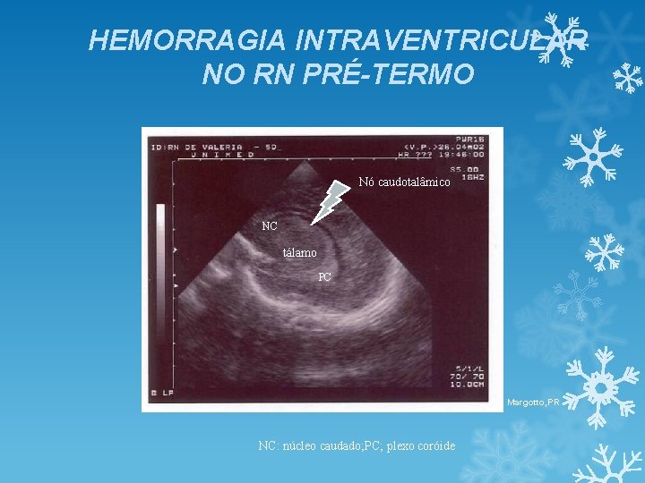 HEMORRAGIA INTRAVENTRICULAR NO RN PRÉ-TERMO Nó caudotalâmico NC tálamo PC Margotto, PR NC: núcleo HEMORRAGIA INTRAVENTRICULAR NO RN PRÉ-TERMO Nó caudotalâmico NC tálamo PC Margotto, PR NC: núcleo