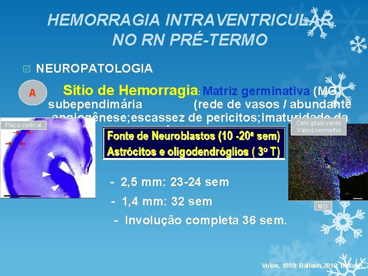HEMORRAGIA INTRAVENTRICULAR NO RN PRÉ-TERMO þ NEUROPATOLOGIA A Placa cortical Sítio de Hemorragia: Matriz HEMORRAGIA INTRAVENTRICULAR NO RN PRÉ-TERMO þ NEUROPATOLOGIA A Placa cortical Sítio de Hemorragia: Matriz
