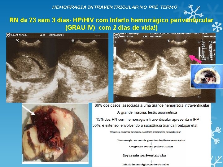 HEMORRAGIA INTRAVENTRICULAR NO PRÉ-TERMO RN de 23 sem 3 dias- HP/HIV com Infarto hemorrágico HEMORRAGIA INTRAVENTRICULAR NO PRÉ-TERMO RN de 23 sem 3 dias- HP/HIV com Infarto hemorrágico