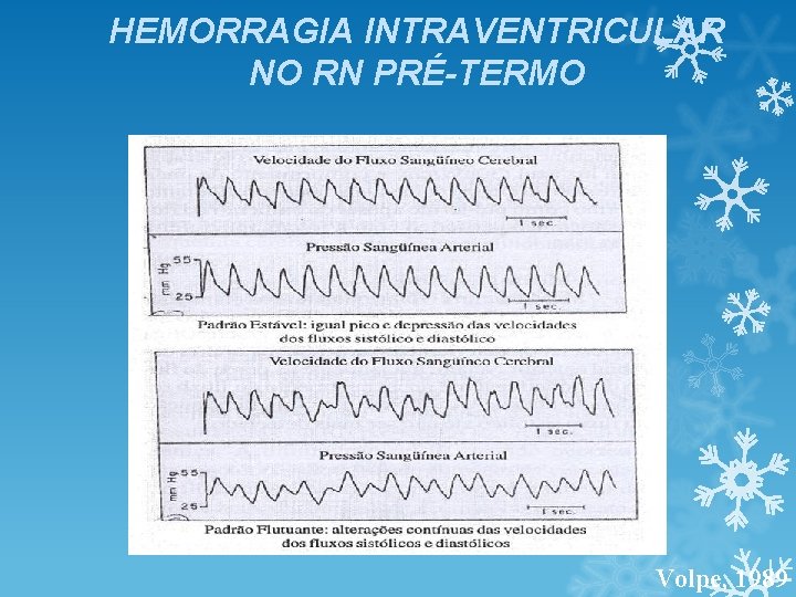 HEMORRAGIA INTRAVENTRICULAR NO RN PRÉ-TERMO Volpe, 1989 HEMORRAGIA INTRAVENTRICULAR NO RN PRÉ-TERMO Volpe, 1989