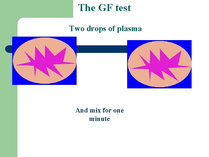 The GF test Two drops of plasma And mix for one minute 