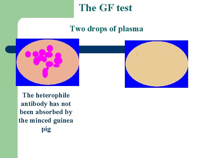 The GF test Two drops of plasma The heterophile antibody has not been absorbed