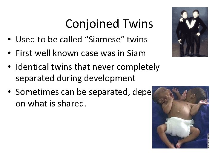 Conjoined Twins • Used to be called “Siamese” twins • First well known case