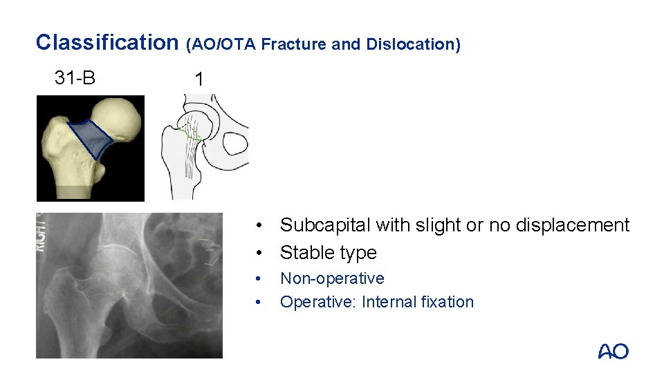 Classification (AO/OTA Fracture and Dislocation) 31 -B 1 • Subcapital with slight or no Classification (AO/OTA Fracture and Dislocation) 31 -B 1 • Subcapital with slight or no