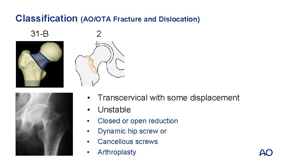 Classification (AO/OTA Fracture and Dislocation) 31 -B 2 • Transcervical with some displacement •