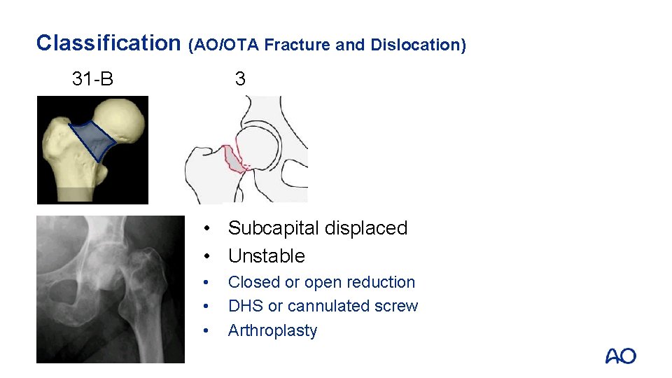 Classification (AO/OTA Fracture and Dislocation) 31 -B 3 • Subcapital displaced • Unstable •