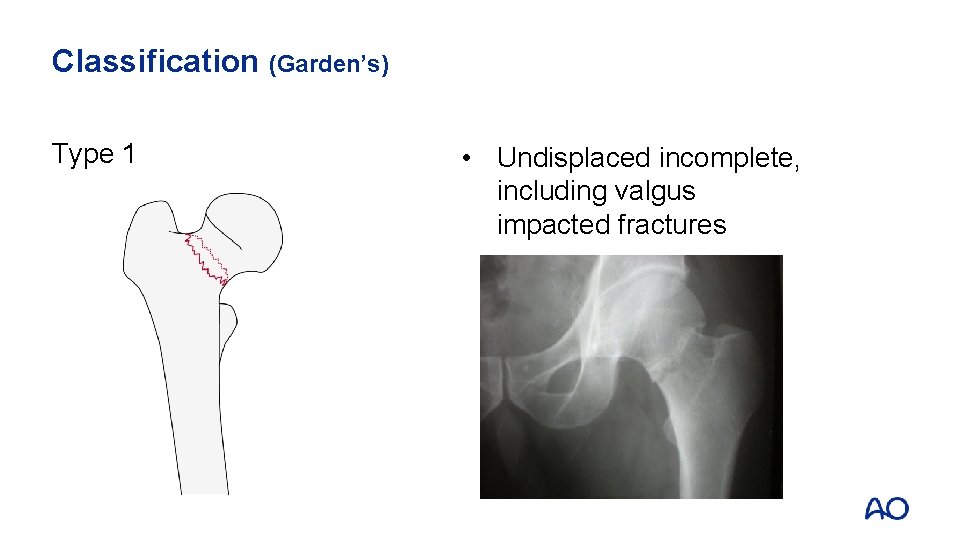 Classification (Garden’s) Type 1 • Undisplaced incomplete, including valgus impacted fractures 