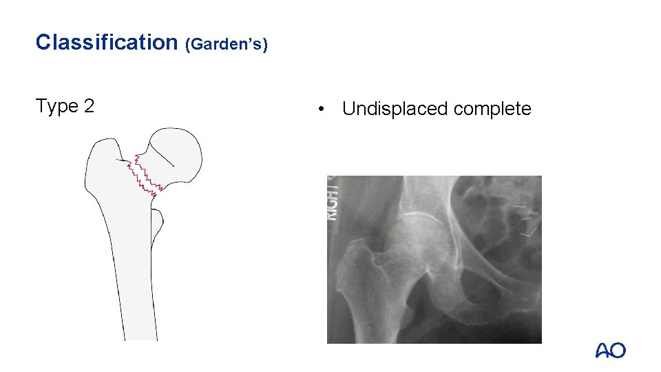 Classification (Garden’s) Type 2 • Undisplaced complete 