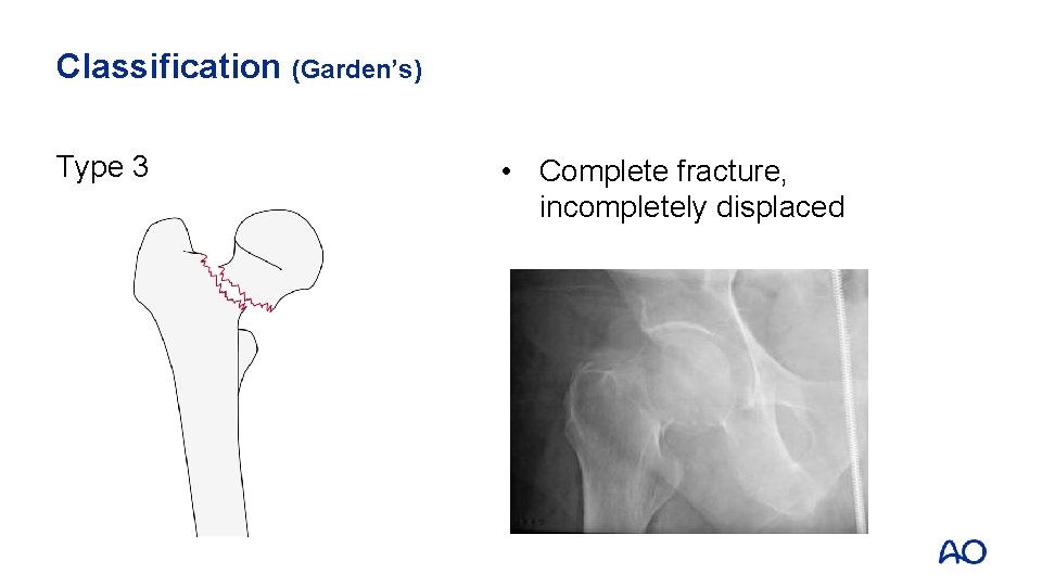 Classification (Garden’s) Type 3 • Complete fracture, incompletely displaced 
