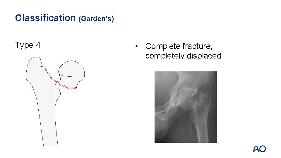 Classification (Garden’s) Type 4 • Complete fracture, completely displaced 