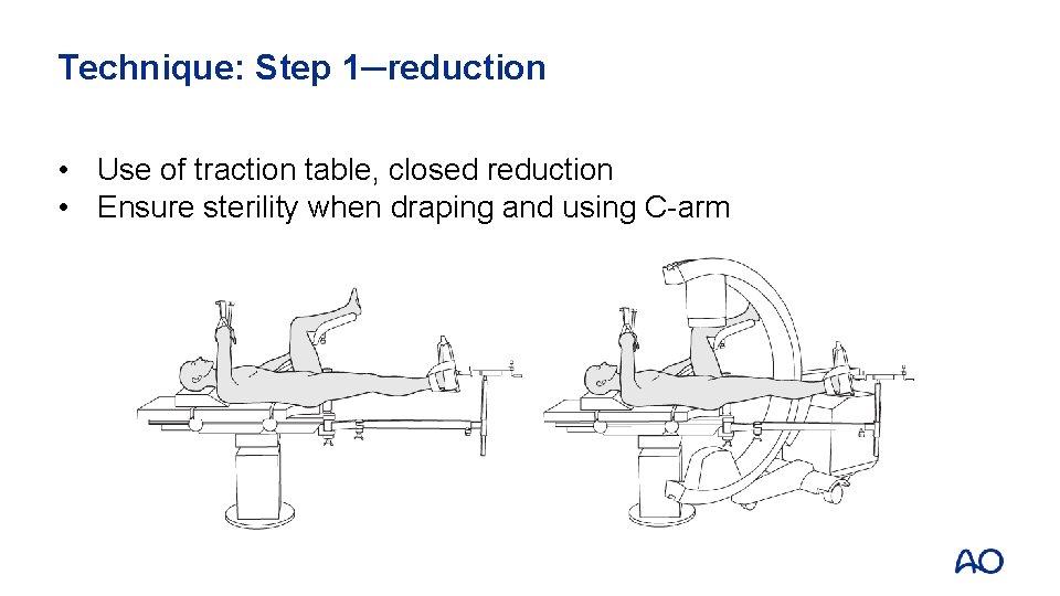 Technique: Step 1─reduction • Use of traction table, closed reduction • Ensure sterility when