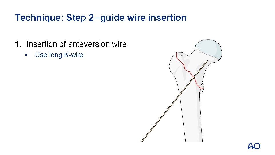 Technique: Step 2─guide wire insertion 1. Insertion of anteversion wire • Use long K-wire