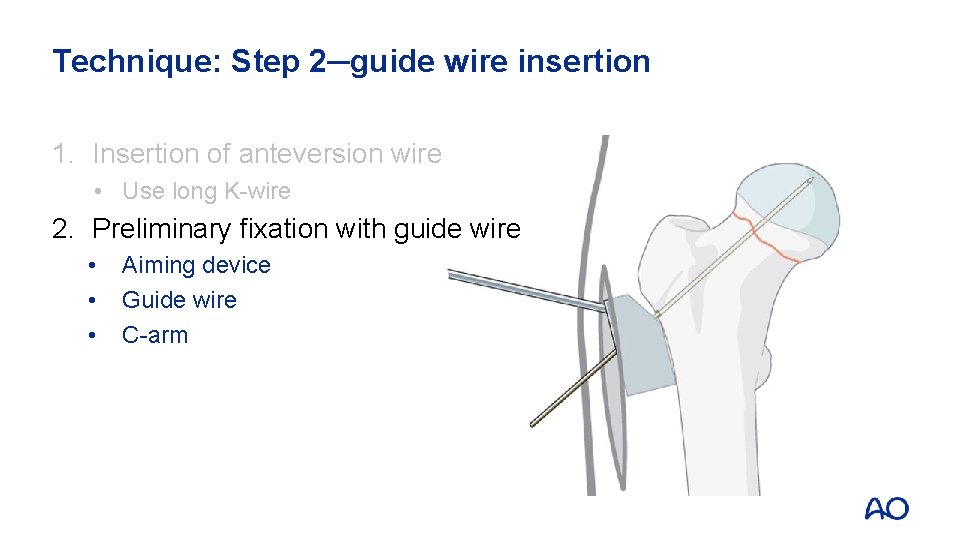 Technique: Step 2─guide wire insertion 1. Insertion of anteversion wire • Use long K-wire