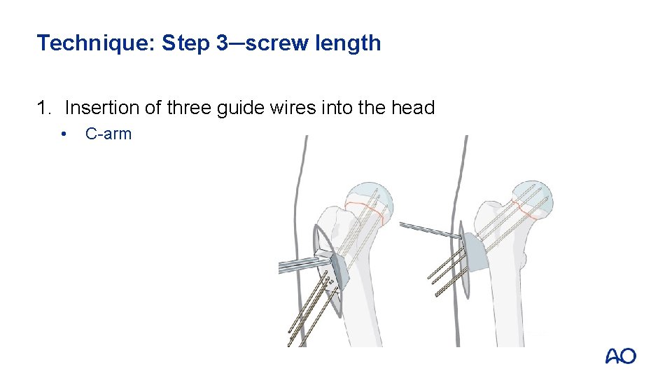 Technique: Step 3─screw length 1. Insertion of three guide wires into the head •