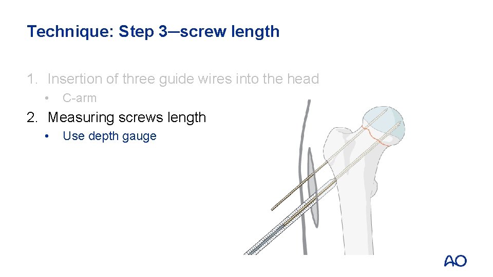Technique: Step 3─screw length 1. Insertion of three guide wires into the head •
