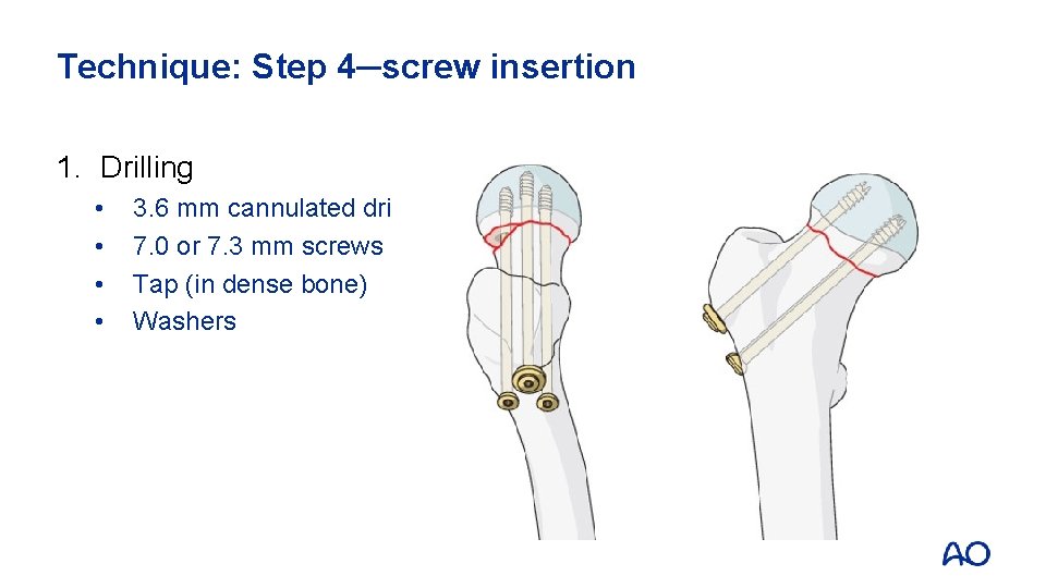 Technique: Step 4─screw insertion 1. Drilling • • 3. 6 mm cannulated drill 7.