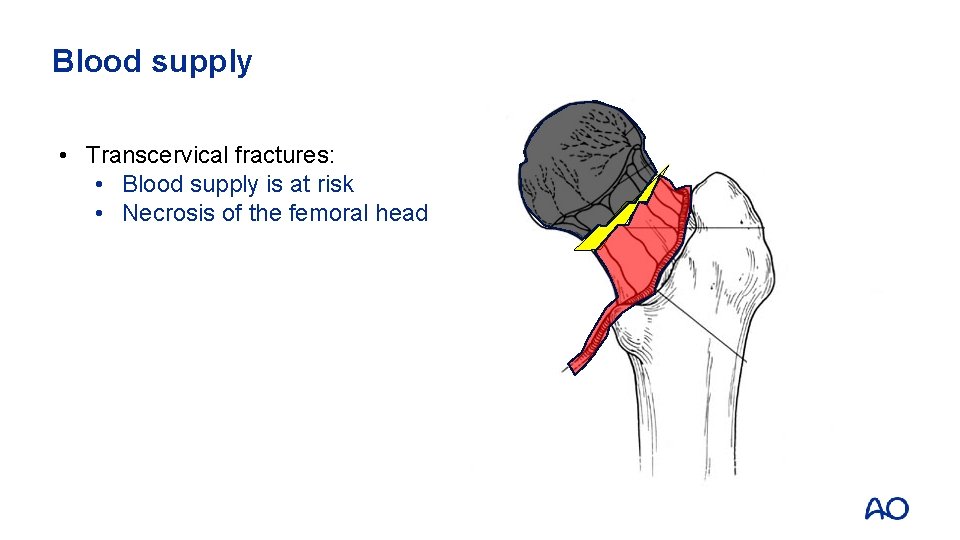 Blood supply • Transcervical fractures: • Blood supply is at risk • Necrosis of