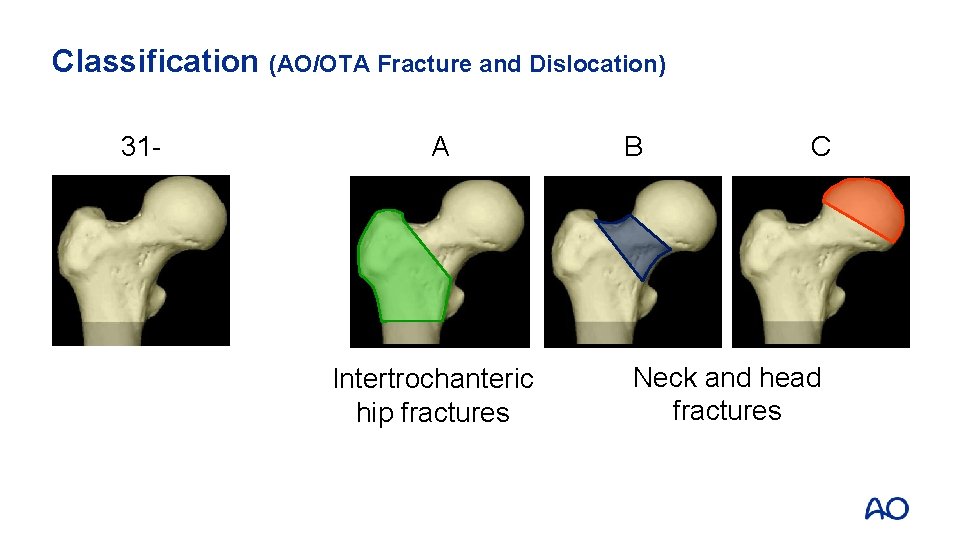 Classification (AO/OTA Fracture and Dislocation) 31 - A Intertrochanteric hip fractures B C Neck