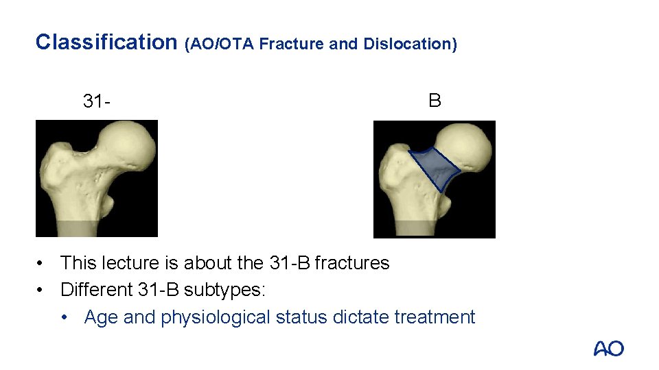 Classification (AO/OTA Fracture and Dislocation) 31 - B • This lecture is about the
