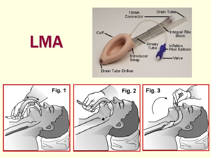 LMA 