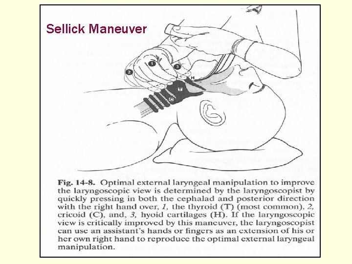 Sellick Maneuver 