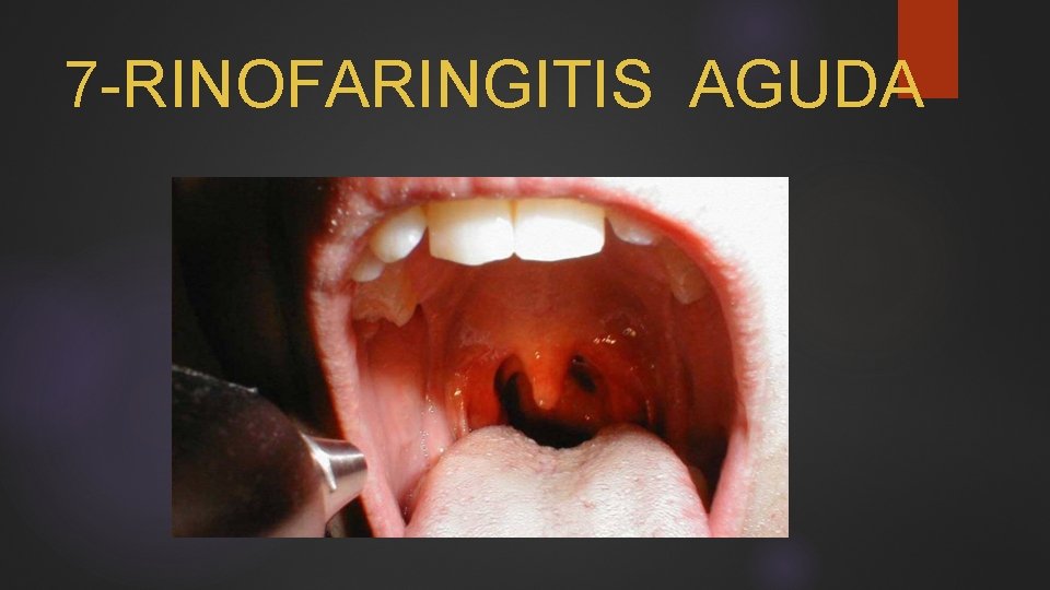 7 -RINOFARINGITIS AGUDA 