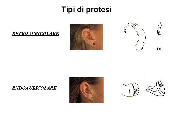 Tipi di protesi RETROAURICOLARE ENDOAURICOLARE 