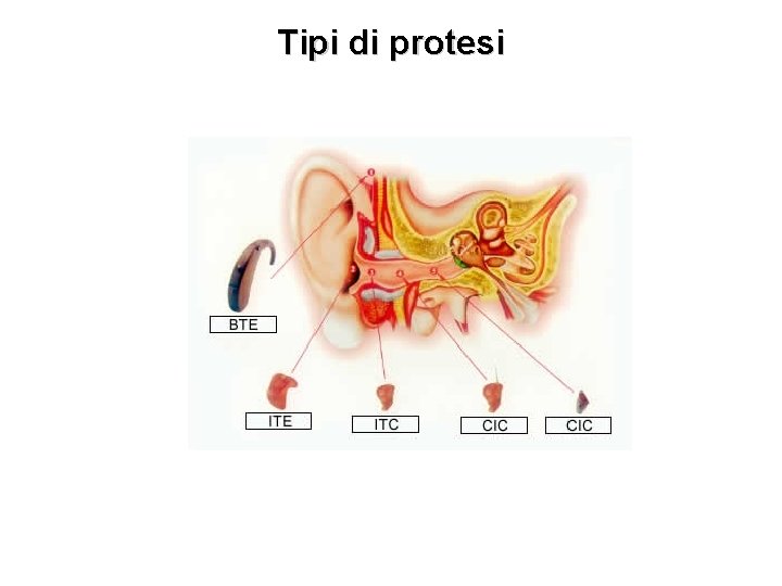 Tipi di protesi 