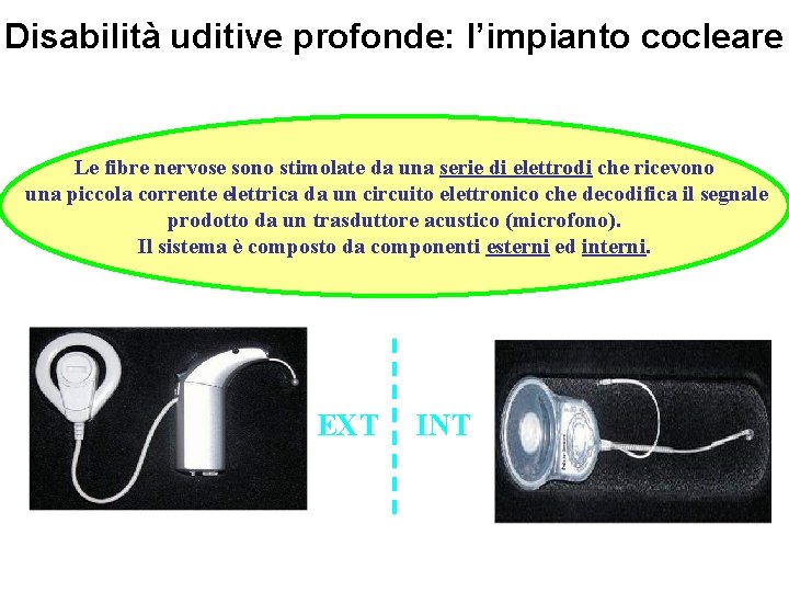 Disabilità uditive profonde: l’impianto cocleare Le fibre nervose sono stimolate da una serie di