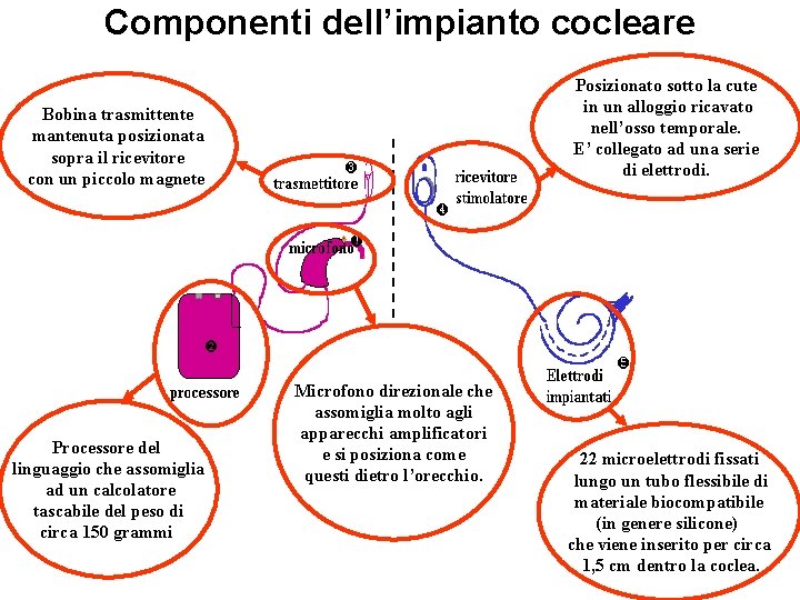 Componenti dell’impianto cocleare Posizionato sotto la cute in un alloggio ricavato nell’osso temporale. E’