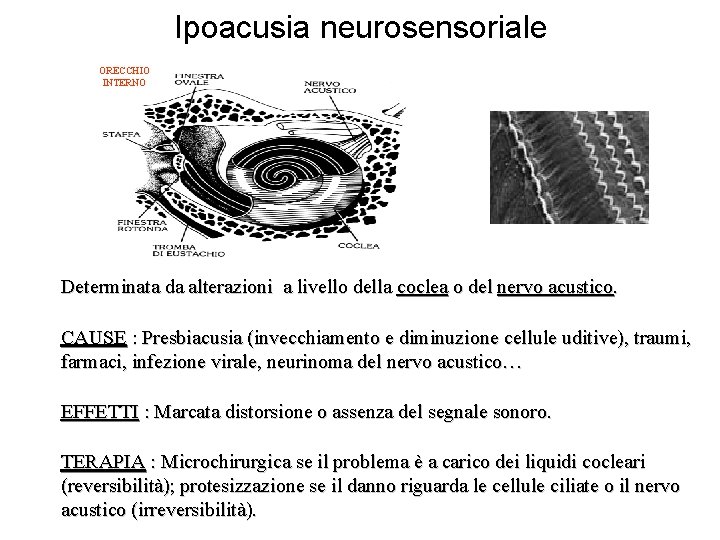 Ipoacusia neurosensoriale ORECCHIO INTERNO Dettaglio cellule ciliate Determinata da alterazioni a livello della coclea