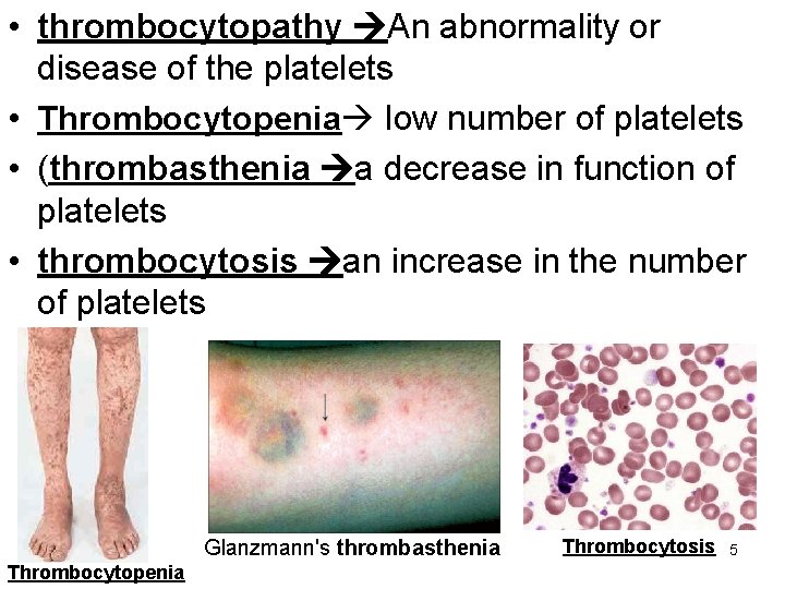  • thrombocytopathy An abnormality or disease of the platelets • Thrombocytopenia low number