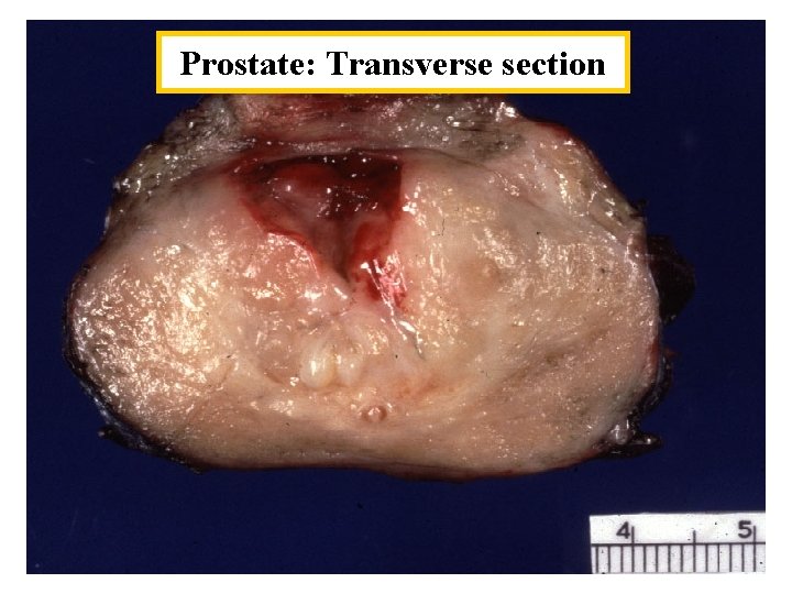 Prostate: Transverse section 