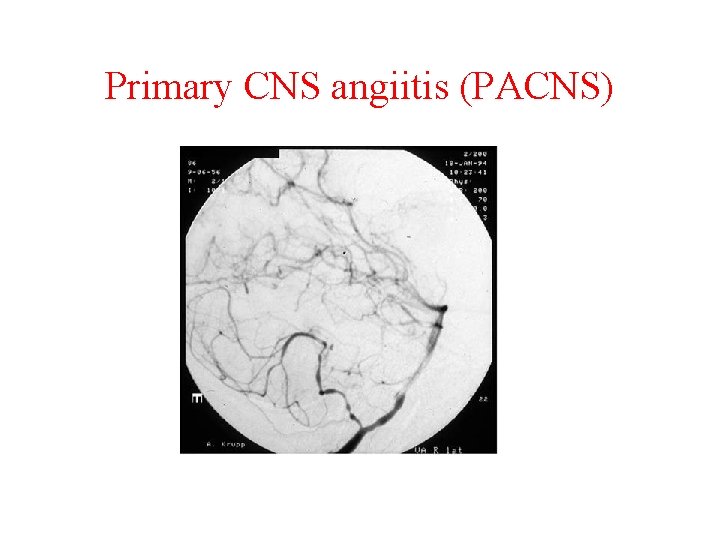 Primary CNS angiitis (PACNS) 