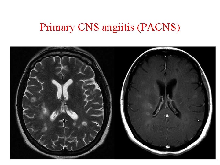 Primary CNS angiitis (PACNS) 