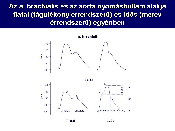 Az a. brachialis és az aorta nyomáshullám alakja fiatal (tágulékony érrendszerű) és idős (merev