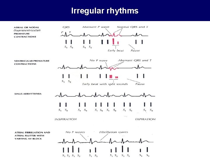 Irregular rhythms 