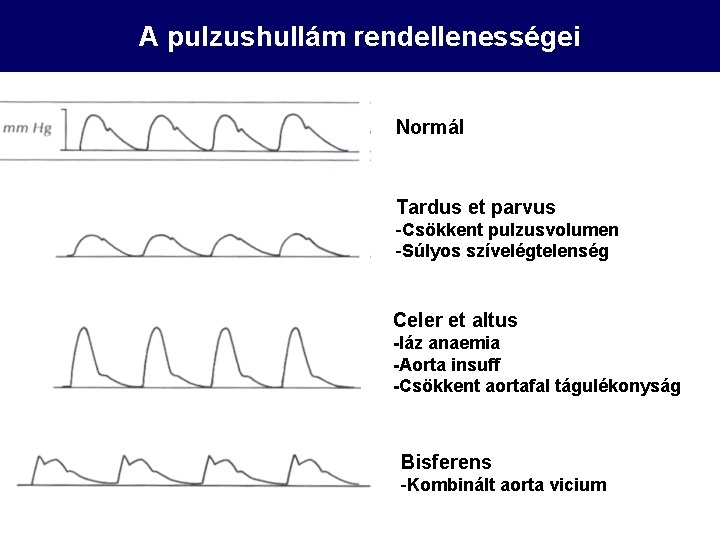 A pulzushullám rendellenességei Normál Tardus et parvus -Csökkent pulzusvolumen -Súlyos szívelégtelenség Celer et altus