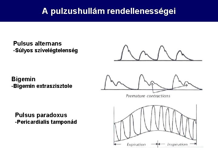 A pulzushullám rendellenességei Pulsus alternans -Súlyos szívelégtelenség Bigemin -Bigemin extraszisztole Pulsus paradoxus -Pericardialis tamponád