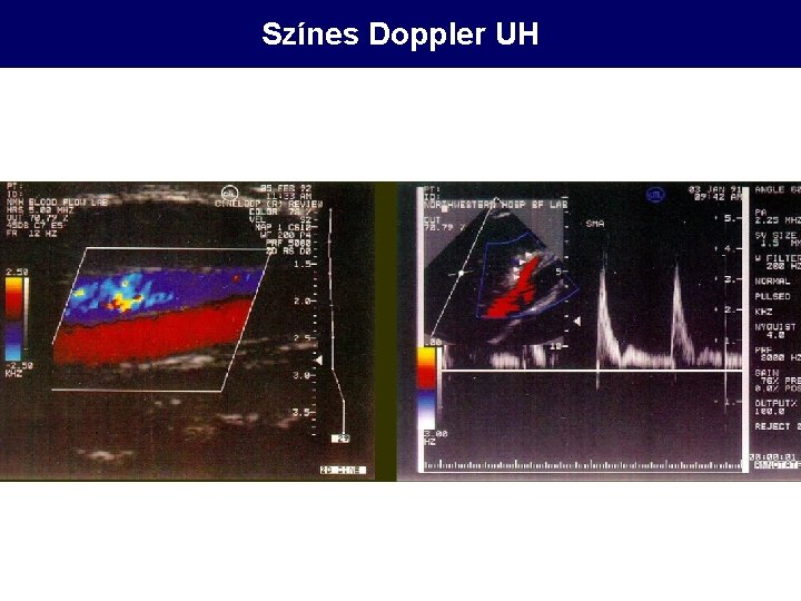 Színes Doppler UH 