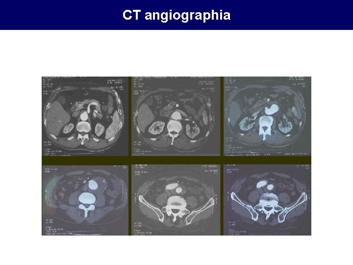 CT angiographia 