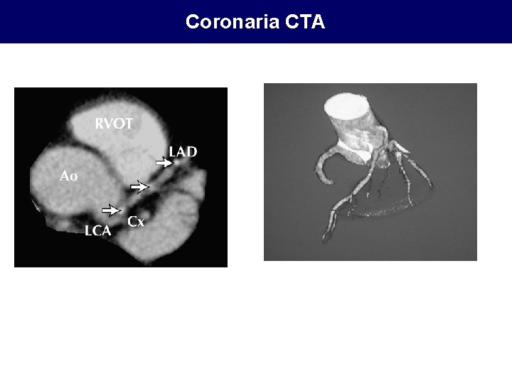 Coronaria CTA 