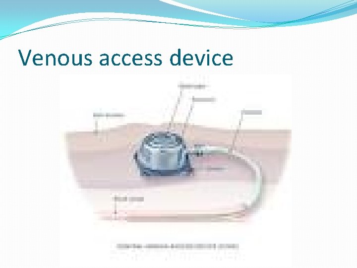 Venous access device 